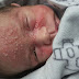 Bebê de 17 dias contrai herpes após beijo de visita e mãe alerta