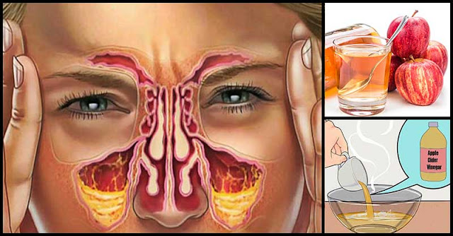 Help Fight Sinus Infection With Apple Cider Vinegar Help Fight Sinus Infection With Apple Cider Vinegar