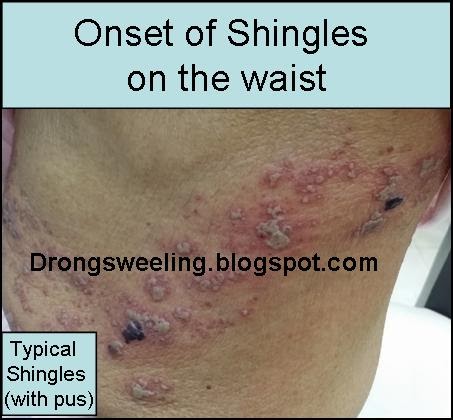 Treatment for shingles in adults, exhibitionism bondage stories