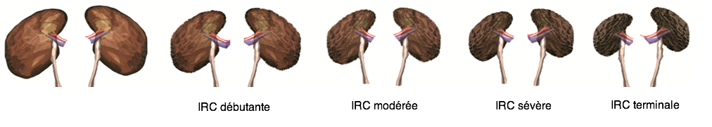 L'insuffisance rénale chronique | Récap' IDE