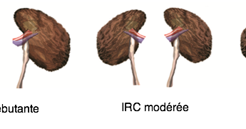 L'insuffisance rénale chronique | Récap' IDE