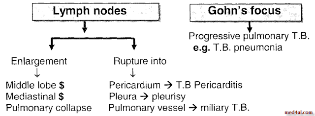 primary-tuberculosis