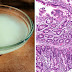 Coconut Oil Breakthrough For Crohn's Disease
