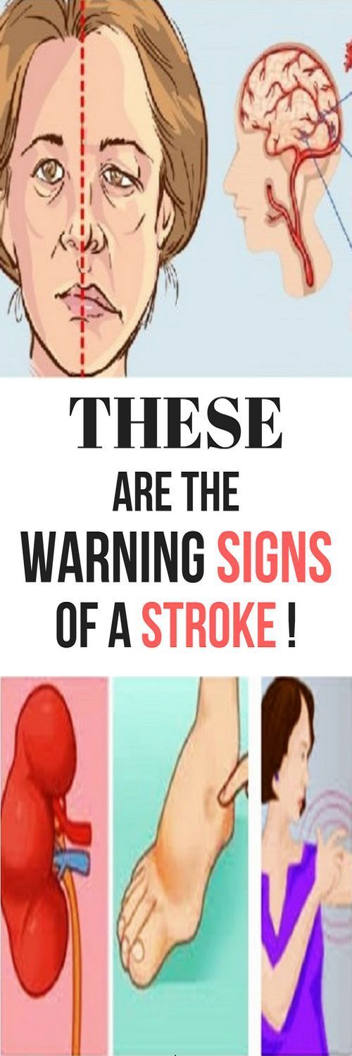 5 Early Warning Sings Of A Stroke You Should Never Ignore Health Recipes