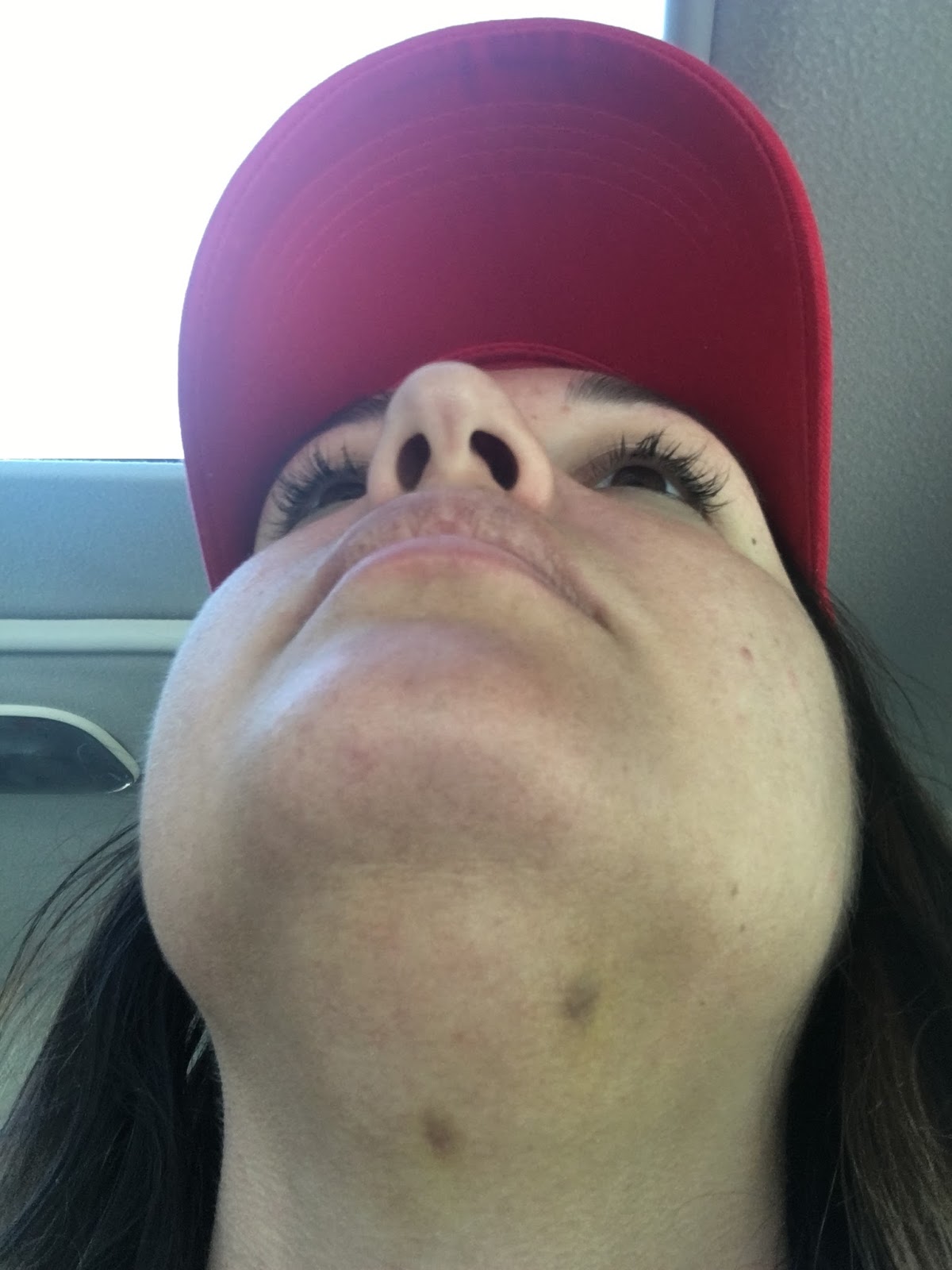 Lump On Jawline Under Skin