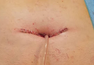 Vesicostomy Definition, Procedure, Complications, Care, Reversal Vesicostomy Definition, Procedure, Complications, Care, Reversal