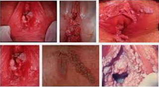 Obat Gatal-Gatal Pada Vagina Obat Gatal-Gatal Pada Vagina