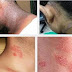 Obat Gatal Di Bagian Leher Paling Ampuh