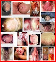 Image Ter sedia obat sipilis | spesial penyakit kelamin
