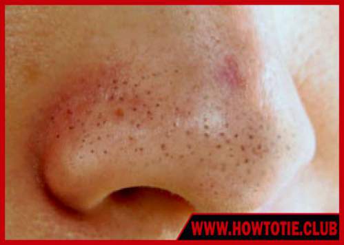 How To Remove Blackheads naturally How To Remove Blackheads naturally