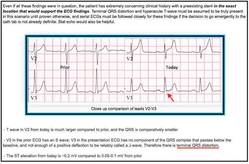 Dr. Smith's ECG Blog Watch what happens when "pericarditis" and