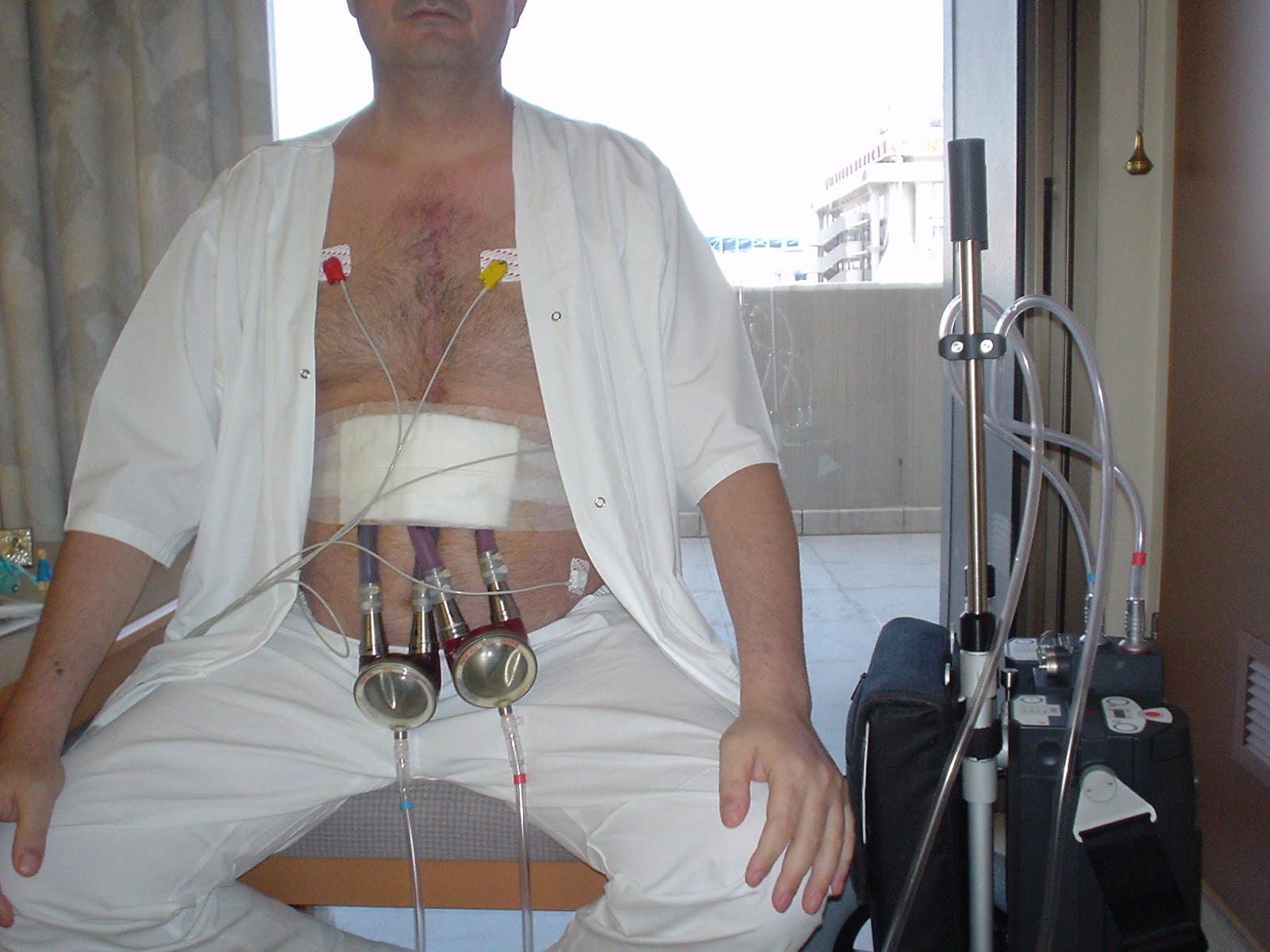 Alphabet soup CHF, LVAD,BiVAD Now for the BiVAD