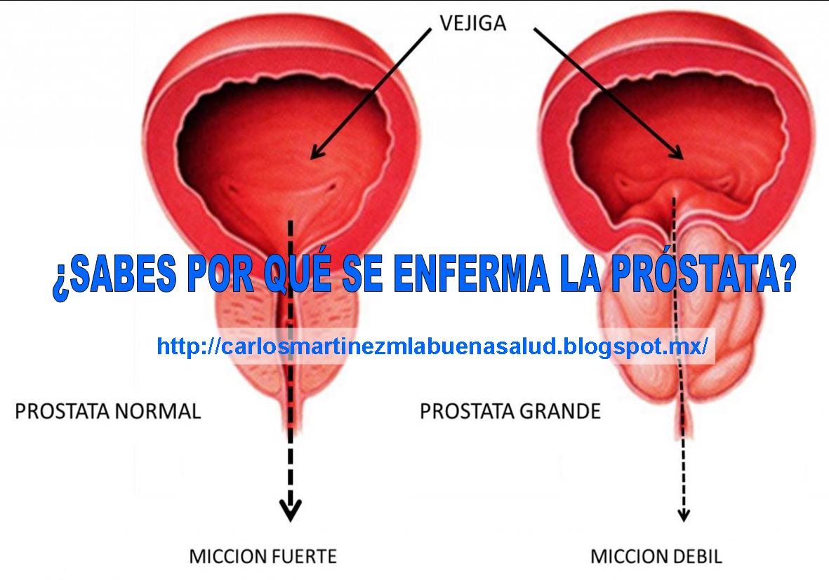 la próstata agrandada causa 23