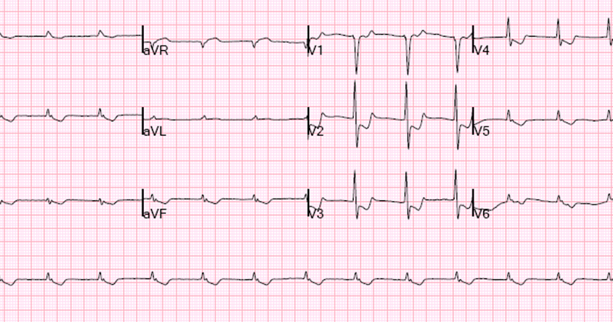 Dr. Smith's ECG Blog Looks like a Posterior STEMI. Is it?