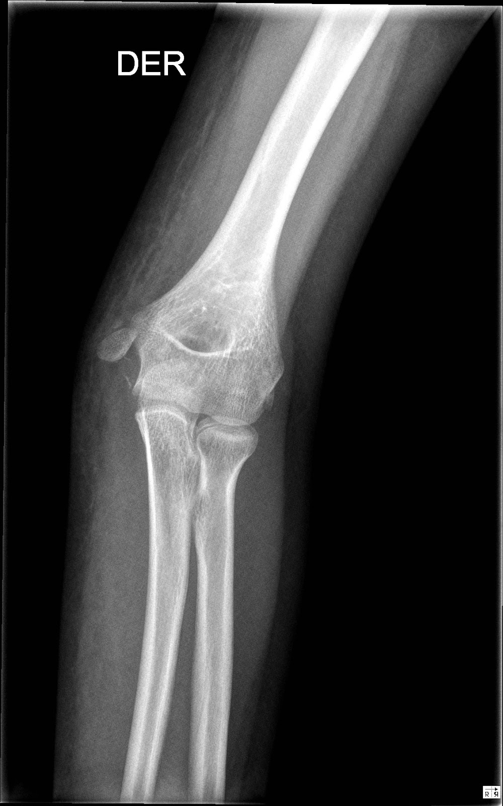 Ortopedia Infantil: 2017-05-28