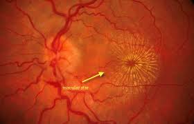 hypertensive retinopathy