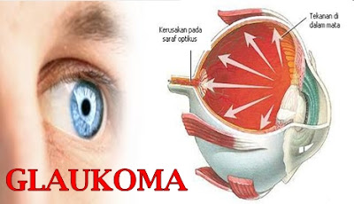 obat glaukoma herbal obat glaukoma herbal