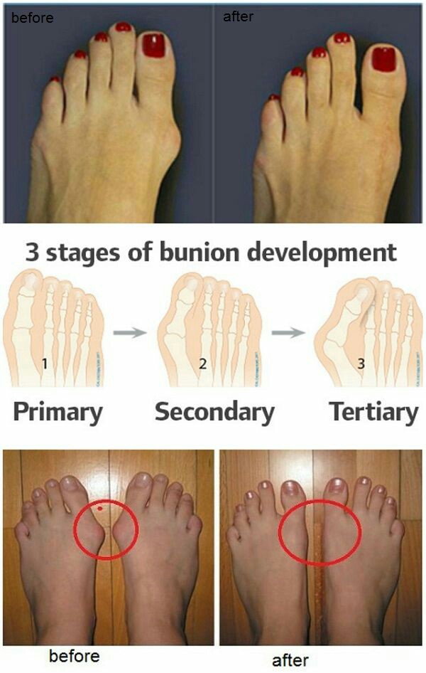 Medical and Health Science Bunion Development!!!