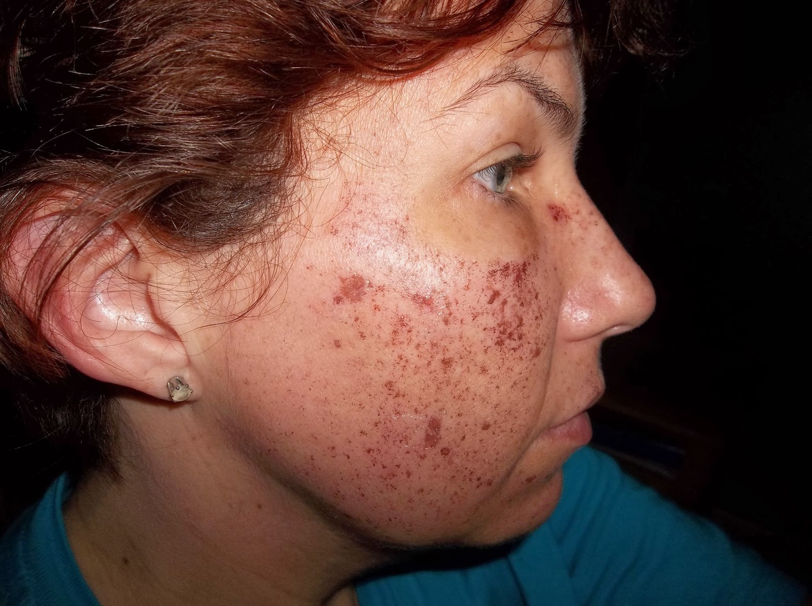 Why Not Start Today: Intense Pulsed Light (IPL) Treatment