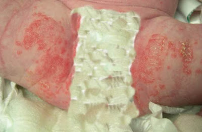 Treatment for diaper rash in babies Best Treatment and prevention for Diaper Rash in Babies