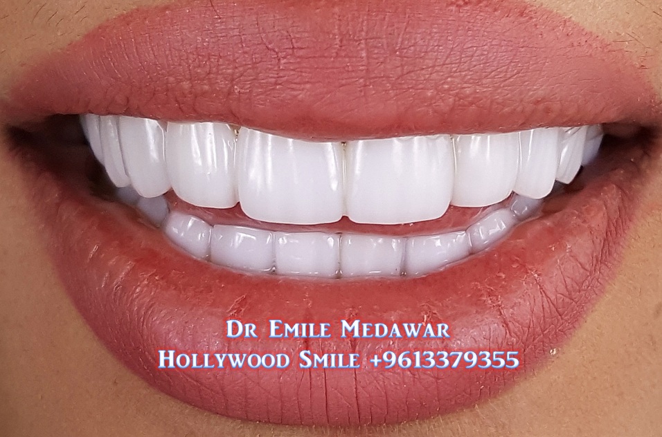 Veneers Style, Dr Emile Medawar, 00961 3 379355 Dental Veneers by Dr