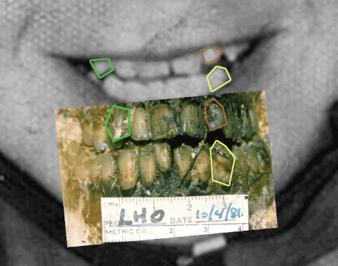 lho-teeth-compare.gif