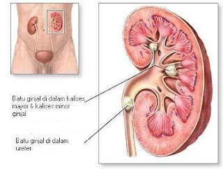 obat herbal penghancur kencing batu ginjal tanpa operasi