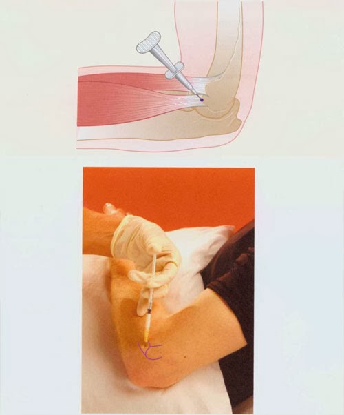 Tenon Injection Common Extensor Tendon Injection ~ Nursing