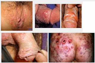 Obat Sipilis Bentol Di Area Kemaluan Obat Sipilis Bentol Di Area Kemaluan