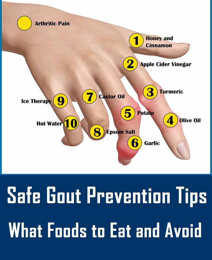 Easy Gout Treatment and Prevention Tips Safe Gout Prevention Tips Don't Delay Gout Treatment