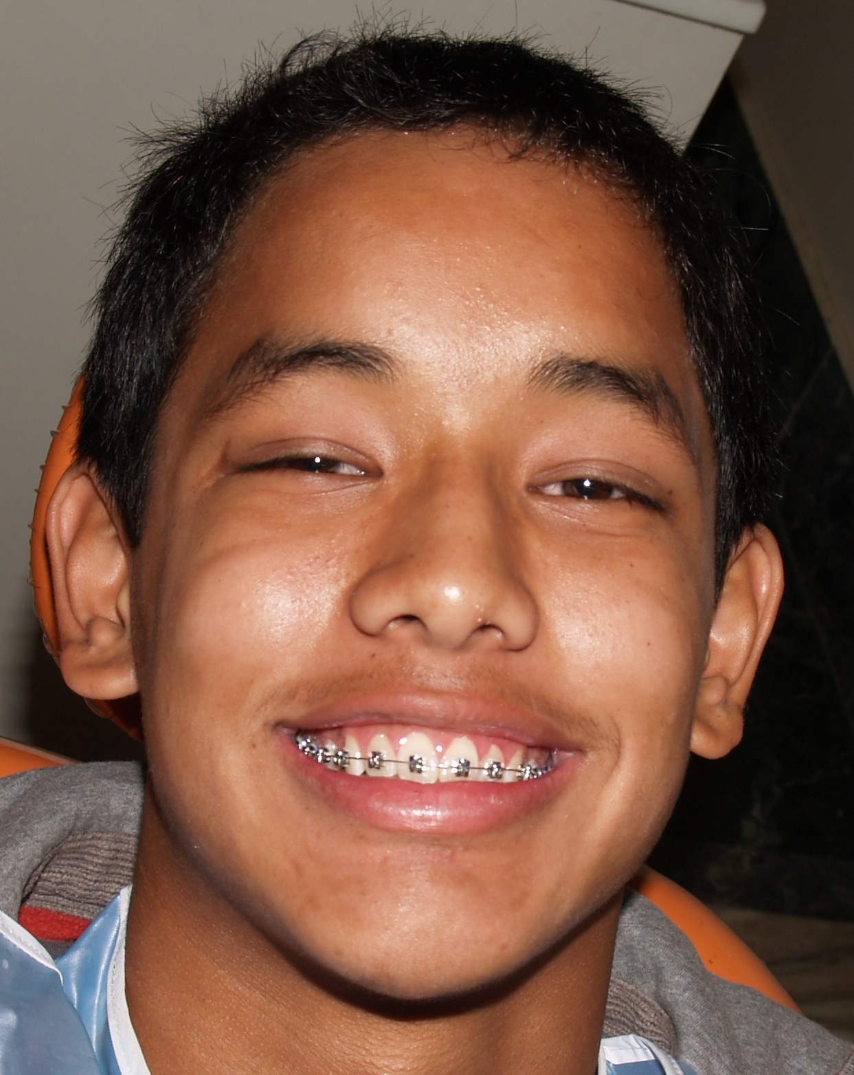 Quick, Accelerated Braces treatment with DAMON SYSTEM