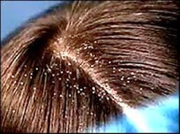 tips cara mengatasi rambut berketombe