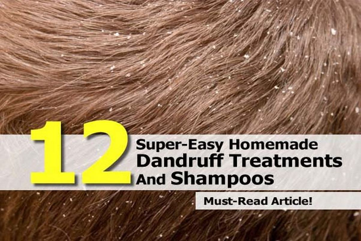 How To Have a Healthy Life 12 Homemade Dandruff Treatments & Shampoos