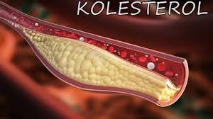 penyakit kolesterol