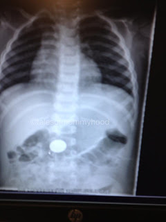x-ray of penny in belly