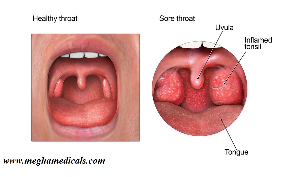 Pictures of sore throat and causes — pic 4