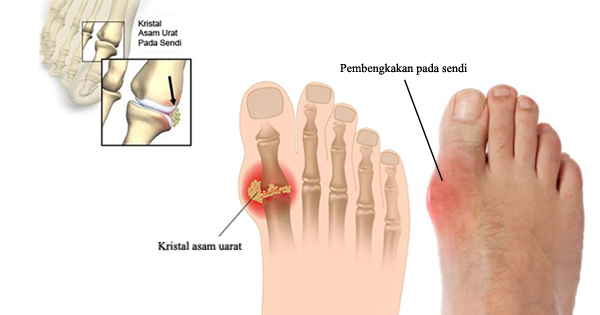 Mengenal Sakit Asam Urat
