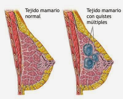 Beneficios de la vitamina e para los quistes