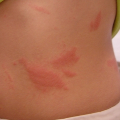 Poison Ivy Rash Treatments Natural Poison Ivy Rash Treatments Natural