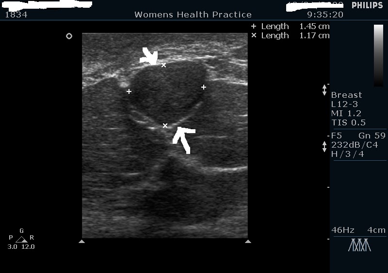 breast lump lumps fibroadenoma cancerous estrogen
