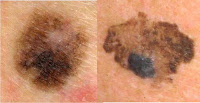 skin cancer pictures early stages