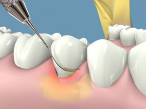 Một số bí quyết cạo vôi răng tại nhà hiệu quả