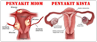 OBAT TRADISIONAL UNTUK GEJALA PENYAKIT MIOM