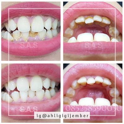 Foto sebelum dan sesudah gigi di bersihkan dari karang gigi, plak dan nikotin