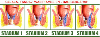 obat alami ambeien luar