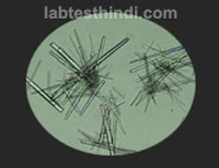 Urine Microscopic - tyrosine crystal