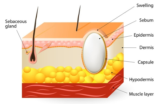 Sebaceous Cyst Home Remedy Sebaceous Cyst Home Remedy