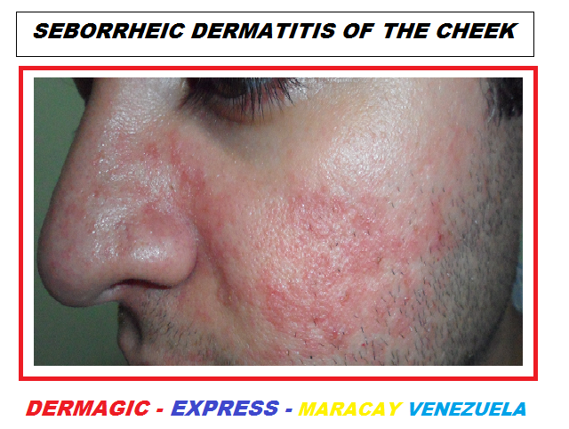 Scalp and facial scaling that may mimic seborrheic dermatitis Fuck the girl next door