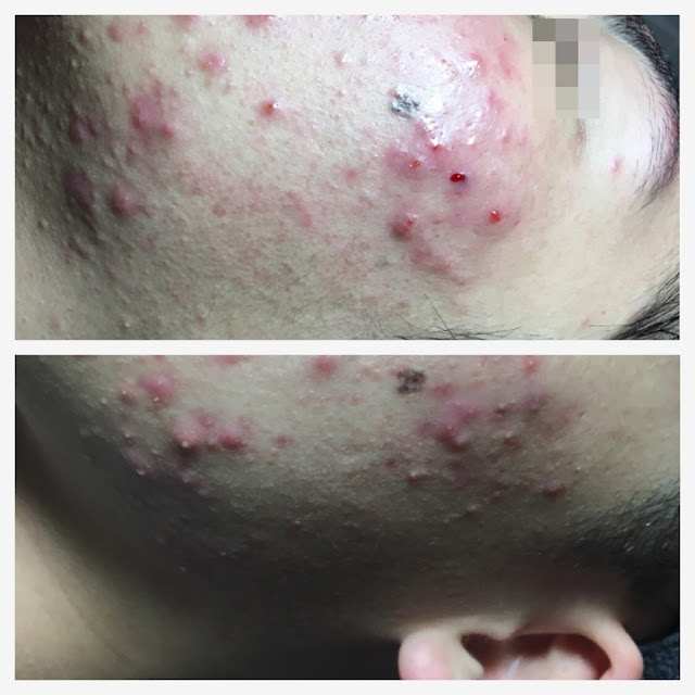 顏之鑽高雄美容做臉清粉刺除痘痘護膚SPA,奎蒂絲杏仁酸精華液, 高雄左營岩盤浴推薦, 高雄全身去角質推薦, 高雄美容沙龍推薦, 高雄美容SPA推薦, 高雄做臉清粉刺推薦, 高雄WAXXXX熱蠟除毛推薦, 顏之鑽高雄美容做臉清粉刺除痘痘護膚SPA,高雄左營美容店,左營美容SPA護膚, 高雄左營做臉,高雄左營做臉推薦,高雄左營做臉分享,高雄左營做臉評價,高雄左營做臉價格, 高雄左營清粉刺,高雄左營清粉刺推薦,高雄左營清粉刺店家,高雄左營清粉刺推薦店家,高雄左營清粉刺價格, 高雄左營清粉刺評價,高雄左營清粉刺分享,高雄左營清粉刺便宜,高雄左營無痛清粉刺,高雄左營擠粉刺, 高雄左營美顏店推薦,高雄左營美顏店家, 高雄左營美容店推薦, 高雄左營熱蠟除毛,高雄左營熱蠟除毛便宜,高雄左營熱蠟除毛分享,高雄左營熱蠟除毛評價,高雄左營熱蠟除毛價格, 高雄左營熱蠟除毛推薦,高雄左營蜜蠟除毛評價,高雄左營蜜蠟除毛便宜,高雄左營蜜蠟除毛價格,高雄左營蜜蠟除毛推薦, 高雄左營腋下除毛評價,高雄左營腋下除毛推薦,高雄左營腋下除毛價格,高雄左營腋下除毛分享,高雄左營腋下除毛便宜, 高雄左營私密處除毛評價,高雄左營私密處除毛推薦,高雄左營私密處除毛價格,高雄左營私密處除毛便宜, 高雄左營岩盤浴SPA,高雄左營岩盤浴,高雄左營岩盤浴推薦,岩盤浴高雄左營