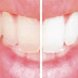 Conheça os 13 piores alimentos e bebidas para os dentes